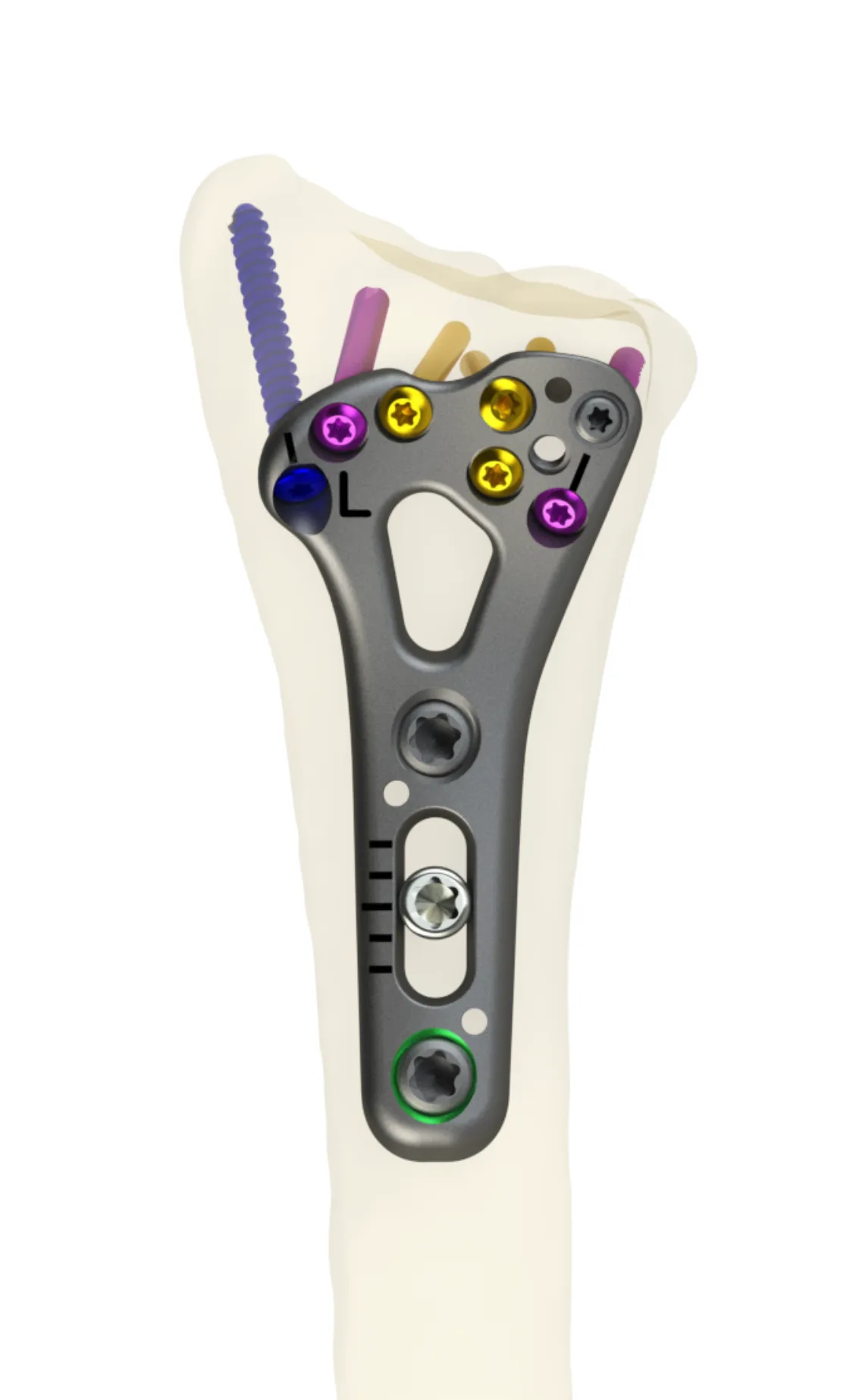 Rendering of the head of a left plate on a translucent distal radius, with gold and purple locking screws and color-coded pins spreading into the joint surface.