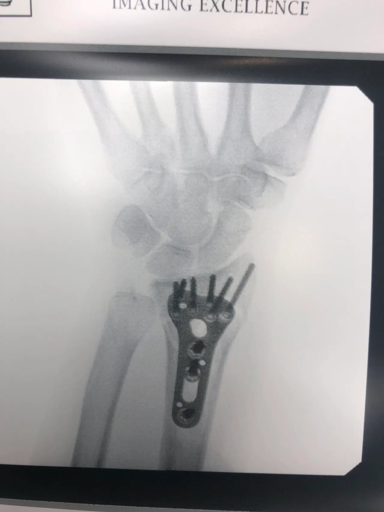 Photo of an X-ray on a monitor showing a wrist with the plate fixed to the distal radius and screws and a pin reaching toward the joint.