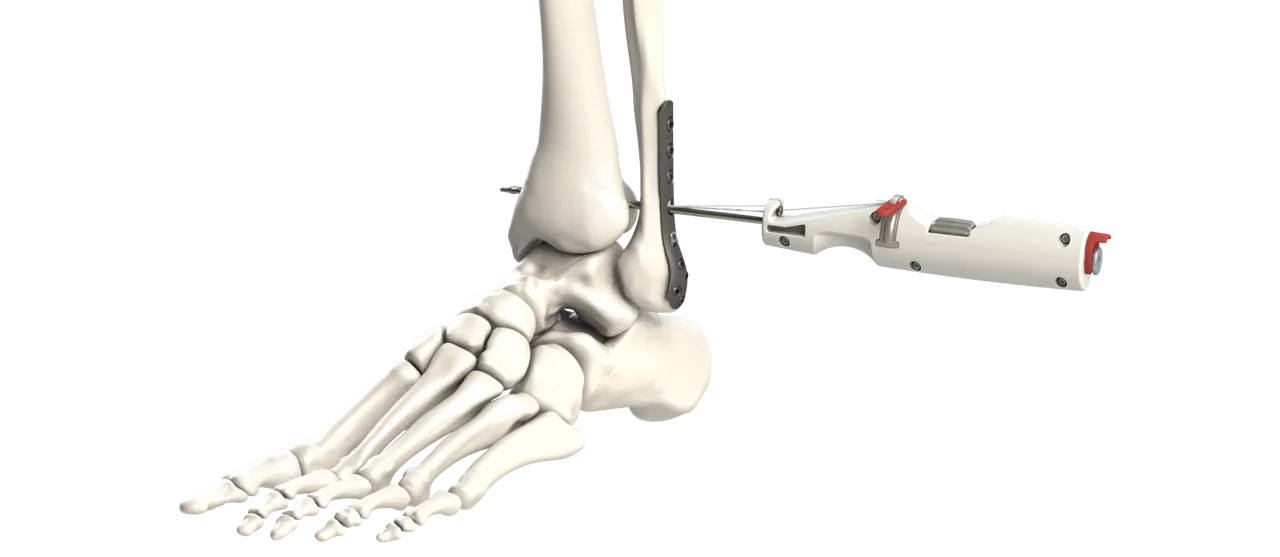 Rendering of a white handheld delivery instrument passing a guide through the fibula and tibia just above the ankle of a foot skeleton, beside a plate on the fibula.