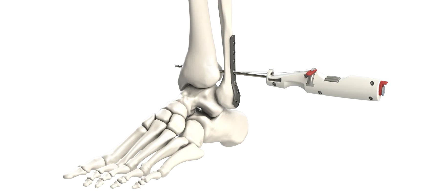 Rendering of a white handheld delivery instrument passing a guide through the fibula and tibia just above the ankle of a foot skeleton, beside a plate on the fibula.