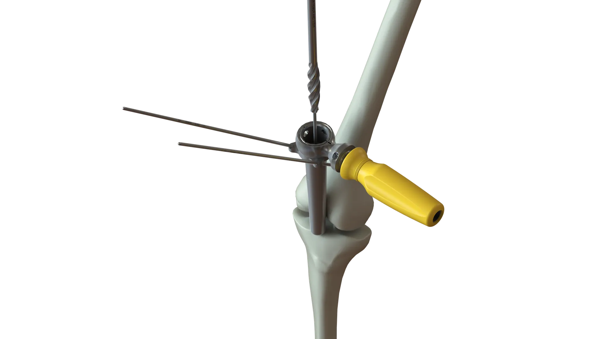 Rendering of a knee skeleton with a cannula entering above the kneecap, held by a yellow-handled guide pinned with two wires, and a reamer passing down through it.