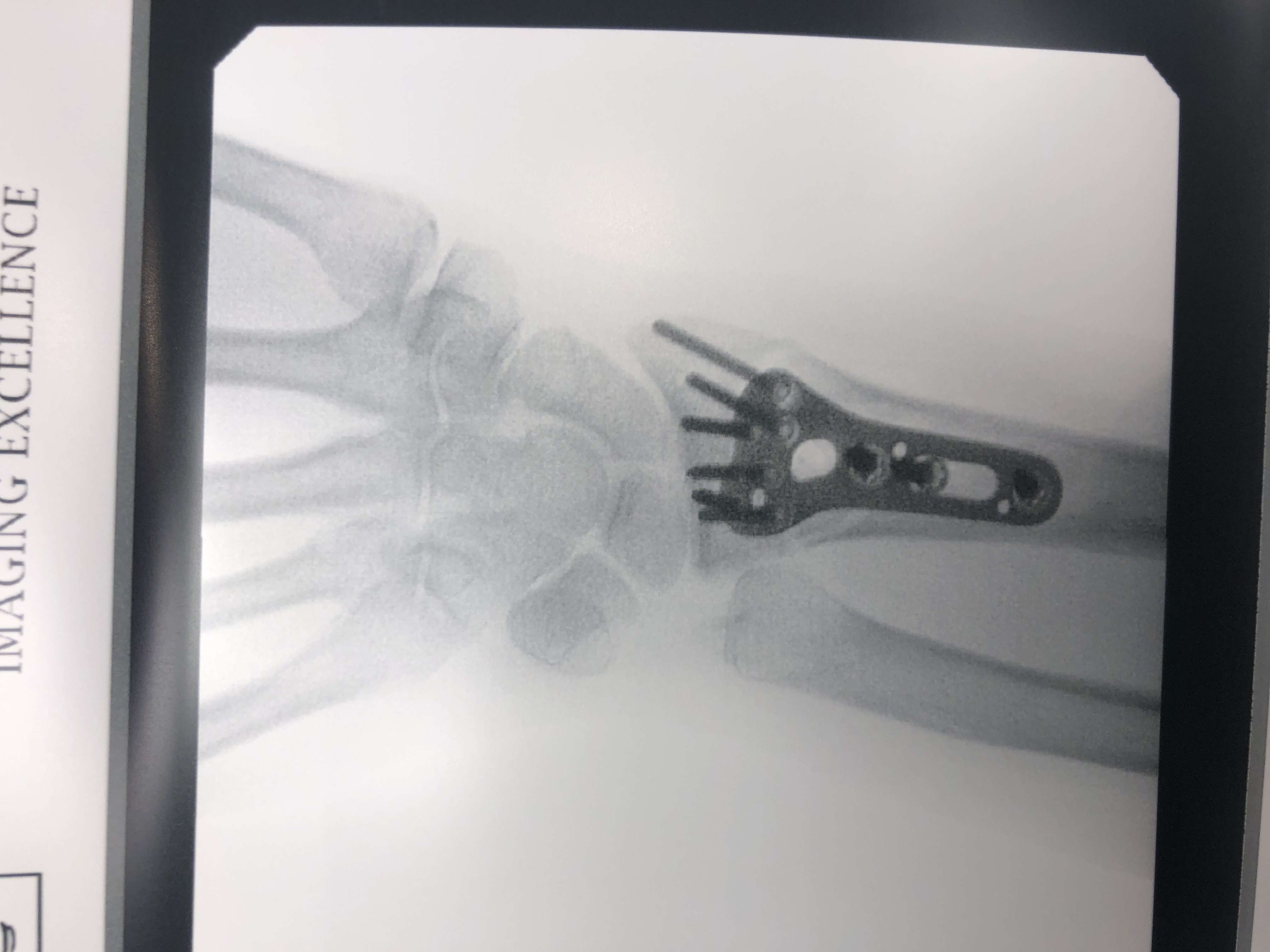 DRPx Distal Radius Plating System — image 4